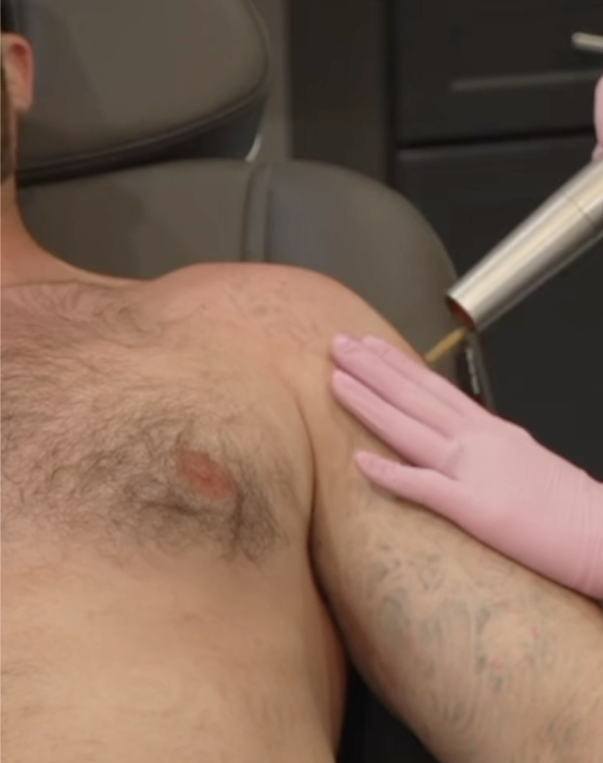 Pain free tattoo removal las vegas no pain tattoo removal summerlin
